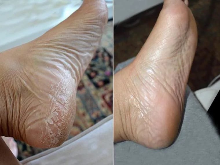 Top Signs You Need a Foot Peel: When and Why to Exfoliate
